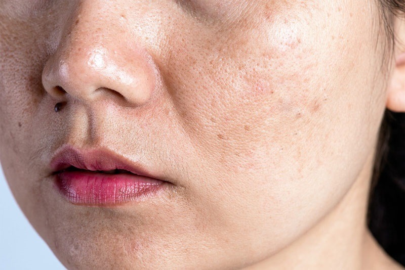 Cách chăm sóc da mặt bị nám như thế nào?